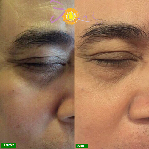 Xóa nhăn, Đánh tan bọng mỡ mắt, Solar spa, Công nghệ Thermage CPT