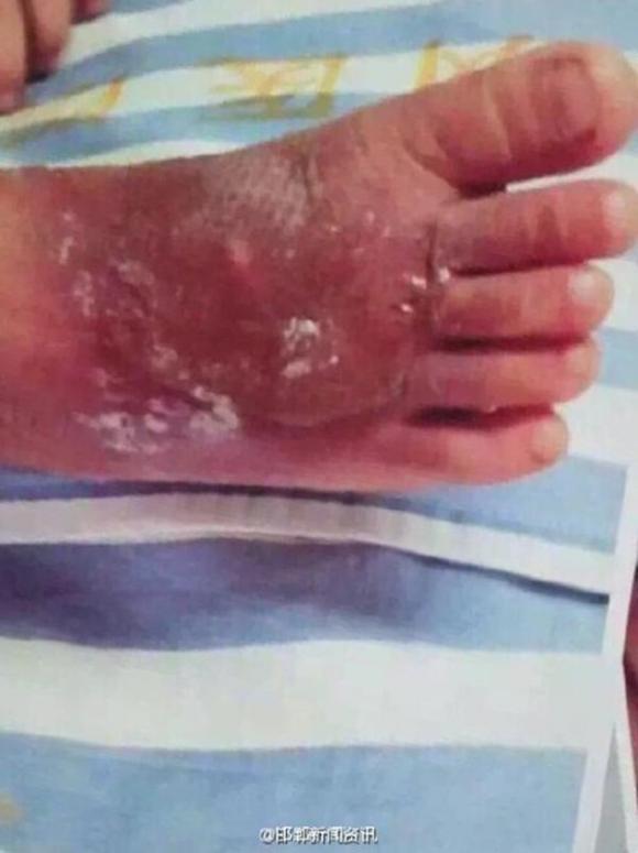 bị bỏng, Bé 2 tuổi bị bỏng cả hai bàn chân vì cô giáo rửa nước quá nóng, nguy hiểm, trẻ em , tai nạn trẻ em, trẻ bi bỏng, ngôi sao