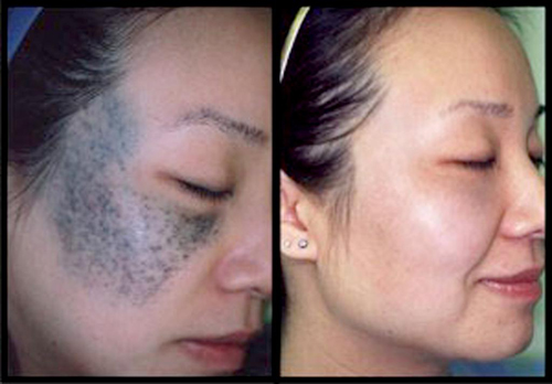 Xóa chàm, Xóa bớt bẩm sinh, Chăm sóc da, Dưỡng da