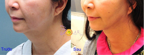 solar-spa-1811-4-ngoisao 0 Trẻ hóa da, Trẻ hóa da không phẫu thuật, Solar spa