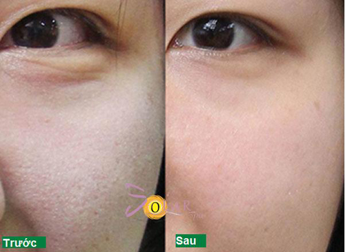 Solar spa, Căng da, Xóa nhăn, Căng da không phẫu thuật