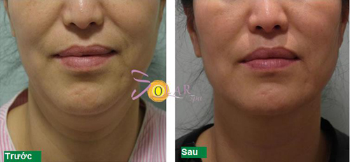 Solar spa, Căng da, Xóa nhăn, Căng da không phẫu thuật