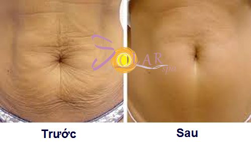 Solar Spa, Căng da mặt, Xóa nhăn, Căng da mặt không phẫu thuật