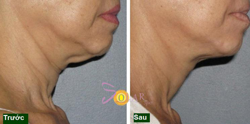 Solar Spa, Căng da mặt, Xóa nhăn, Căng da mặt không phẫu thuật