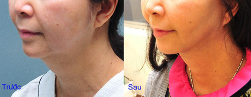 Solar Spa, Trẻ hóa da, Căng da, Solar Spa khuyến mại