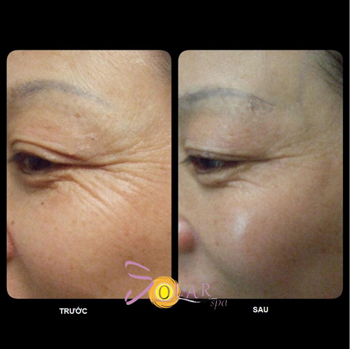 Căng da mặt, Trẻ hóa da, Solar Spa