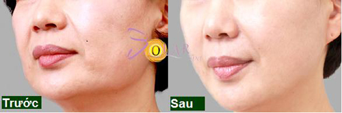 Solar Spa, Trẻ hóa da mặt, Trẻ hóa da mặt 1 lần duy nhất không phẫu thuật