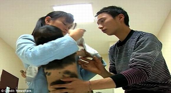 nốt ruồi mọc lông, nốt ruồi mọc lông bao trùm cơ thể, nốt ruồi, tin, bao