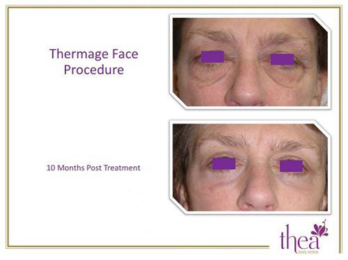 thea-1712-ngoisao 0 Thea Beauty Solutions, Thẩm mỹ viện Thea, Làm trắng da