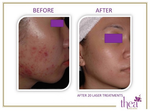 thea-beauty-1712-6-ngoisao 2 Thea Beauty Solutions, Thẩm mỹ viện Thea, Làm trắng da