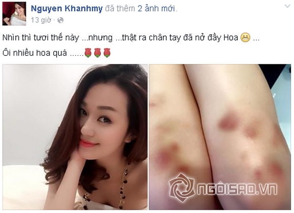 khánh my,khánh my bầm dập,chân khánh my nở đầy hoa