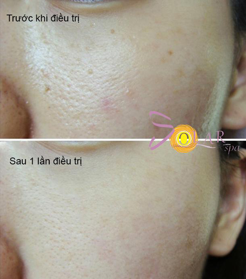 Xóa sẹo thâm, Thu hẹp lỗ chân lông, Solar spa