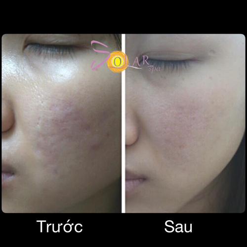 Xóa sẹo thâm, Thu hẹp lỗ chân lông, Solar spa