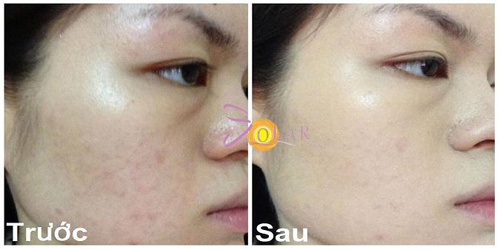 Xóa sẹo thâm, Thu hẹp lỗ chân lông, Solar spa