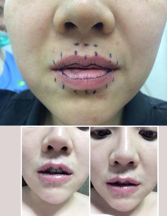 Loạt ảnh trước và sau khi phẫu thuật cắt môi đầy đau đớn của giới trẻ