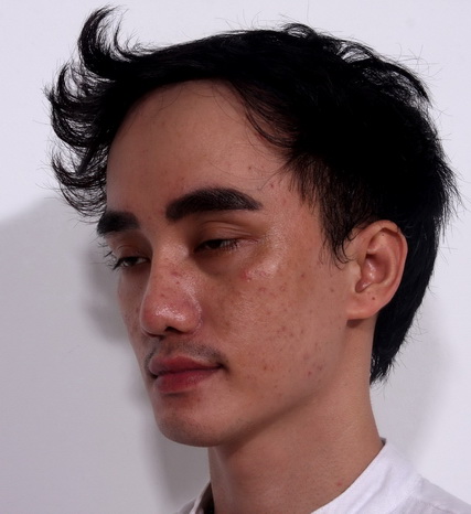 ha-nhuan-nam-121-2-ngoisao 13 Bệnh viện Thẩm mỹ Hiệp Lợi, Hà Nhuận Nam, Hot boy dao kéo