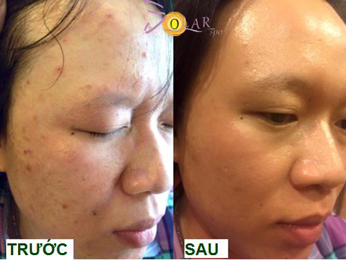 Xóa thâm, Trị sạch mụn, Solar spa