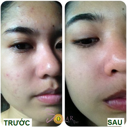 Xóa thâm, Trị sạch mụn, Solar spa