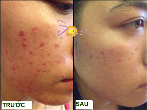 Xóa thâm, Trị sạch mụn, Solar spa