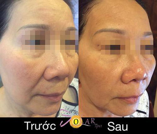 Solar Spa, Nâng cơ, Trẻ hóa da