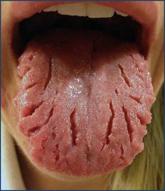 lưỡi, vấn đề của lưỡi, nhìn lưỡi đoán bệnh