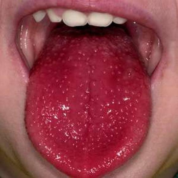 lưỡi, vấn đề của lưỡi, nhìn lưỡi đoán bệnh