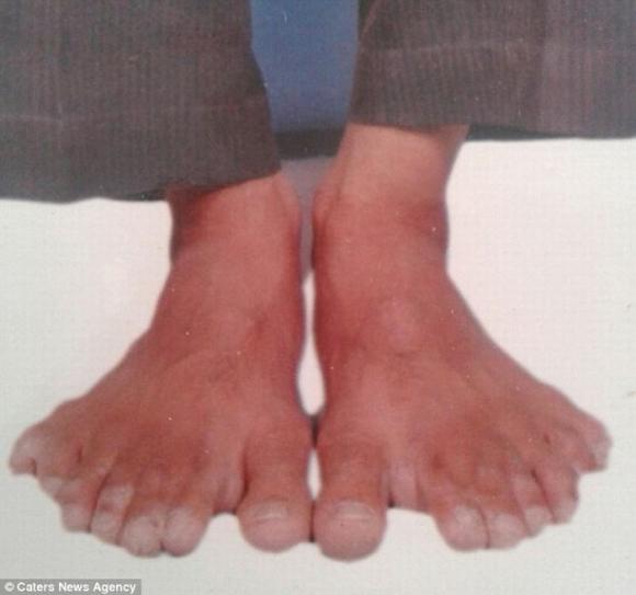 dị nhân, người đàn ông dị nhân, dị nhân có 14 ngón tay 14 ngón chân