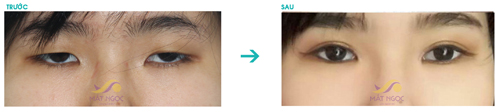 Viện thẩm mỹ Mắt Ngọc, Phẫu thuật mắt to, Mắt đẹp