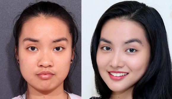 tham-my-hiep-loi-73-1-ngoisao 4 Bệnh viện Thẩm mỹ Hiệp Lợi, Sửa mũi, Độn cằm