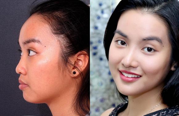 tham-my-hiep-loi-73-2-ngoisao 3 Bệnh viện Thẩm mỹ Hiệp Lợi, Sửa mũi, Độn cằm