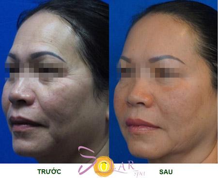 solar-143-3-ngoisao 2 Solar spa, Trẻ hóa da, Trẻ hóa da không phẫu thuật