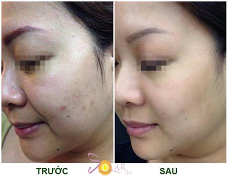 solar-143-4-ngoisao 1 Solar spa, Trẻ hóa da, Trẻ hóa da không phẫu thuật