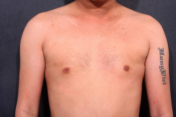 Chuyên gia trang điểm Hùng Việt, Bệnh viện Thẩm mỹ Hiệp Lợi, Nâng ngực nam giới