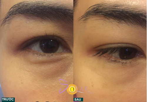 Solar spa, Xóa nhăn, Đánh tan bọng mỡ mắt 