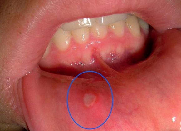 tác hại cắn móng tay, lý do nên dừng việc cắn móng tay, hậu quả cắn móng