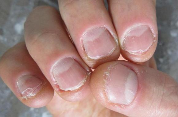 tác hại cắn móng tay, lý do nên dừng việc cắn móng tay, hậu quả cắn móng