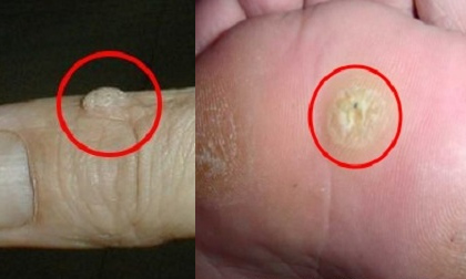 mụn nước trên ngón tay, dấu hiệu nhận biết bệnh qua mụn nước, hình ngón tay nói lên bệnh tật