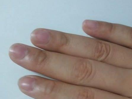 mụn nước trên ngón tay, dấu hiệu nhận biết bệnh qua mụn nước, hình ngón tay nói lên bệnh tật