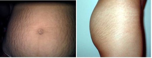 Rạn da, Kem xóa vết rạn, Trị rạn da