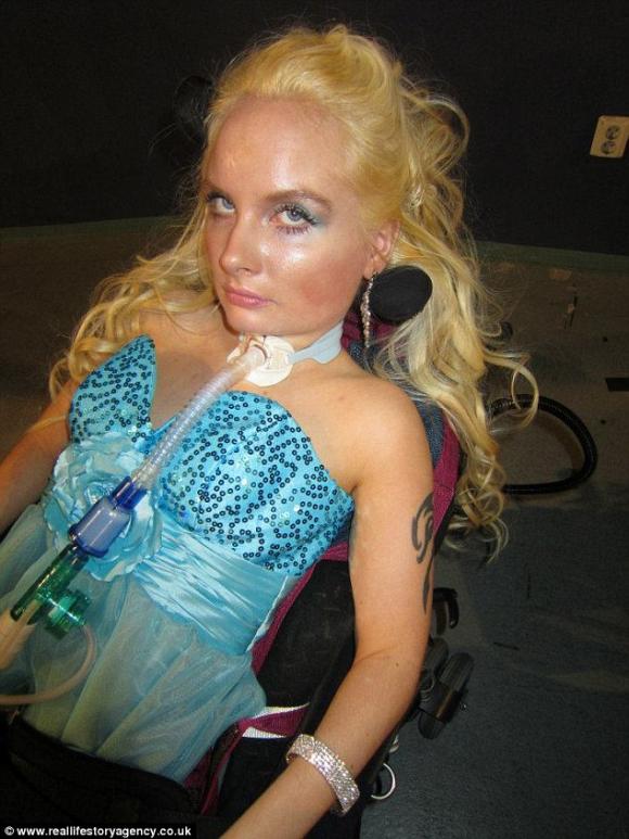 búp bê Barbie, phẫu thuật giống búp bê Barbie,  Barbie, cô gái khuyết tật, phẫu thuật thẩm mỹ, đời sống trẻ