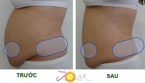 solar-spa-65-2-ngoisao 3 Giảm béo, Công nghệ giảm béo, Công nghệ điều trị hủy mỡ hoàn toàn, Solar Spa
