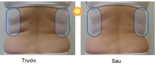 solar-spa-65-3-ngoisao 2 Giảm béo, Công nghệ giảm béo, Công nghệ điều trị hủy mỡ hoàn toàn, Solar Spa