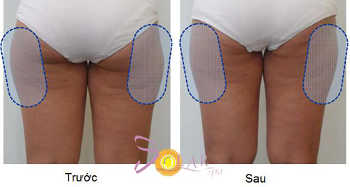 solar-spa-65-4-ngoisao 1 Giảm béo, Công nghệ giảm béo, Công nghệ điều trị hủy mỡ hoàn toàn, Solar Spa