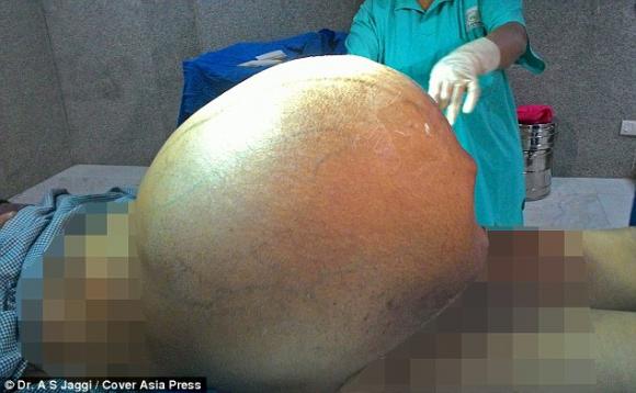khối u buồng trứng nặng gần 97kg, khối u buồng trứng, cô gái mang khối u buồng trứng nặng gần 97kg