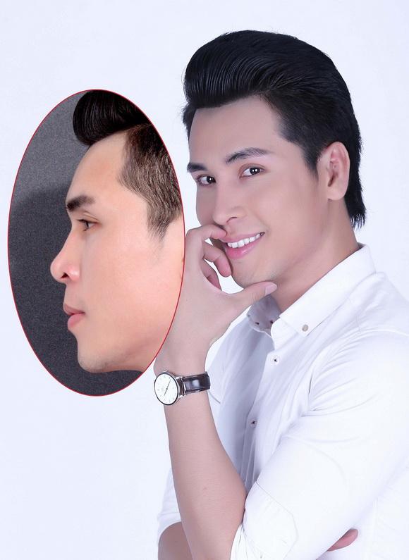 hoang-phi-kha-125-3-ngoisao 4 Hoàng Phi Kha, Phẫu thuật sửa mũi, Bệnh viện thẩm mỹ Hiệp Lợi