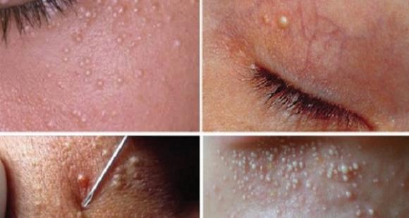 hủy bỏ các nang da trắng nhỏ?, trị mụn. loại bỏ mụn thịt, làm đẹp, keratin