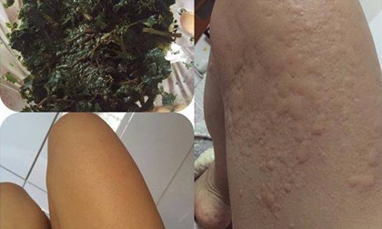 mề đay, rau kinh giới, chữa mẩn ngứa, chữa bệnh ngứa
