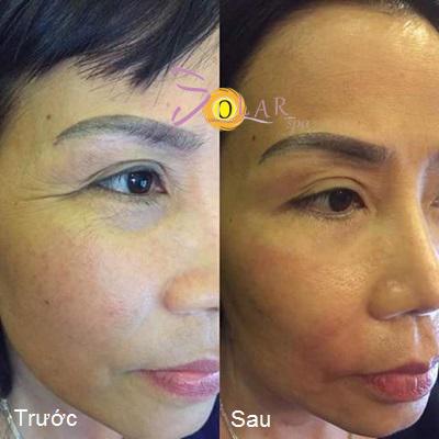 solar-245-1-ngoisao 4 Xóa nhăn, Nâng cơ mặt, Solar spa, Solar spa khuyến mại