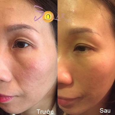 solar-245-2-ngoisao 3 Xóa nhăn, Nâng cơ mặt, Solar spa, Solar spa khuyến mại