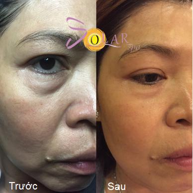 solar-245-3-ngoisao 2 Xóa nhăn, Nâng cơ mặt, Solar spa, Solar spa khuyến mại